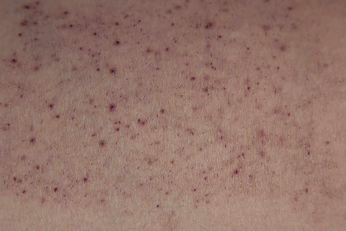 表層皮膚_06的封面圖