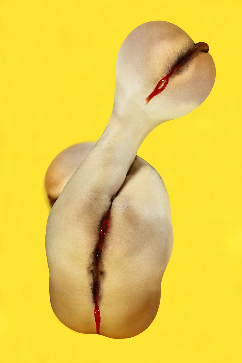 The Injection of Rubber Prostate—1's Cover